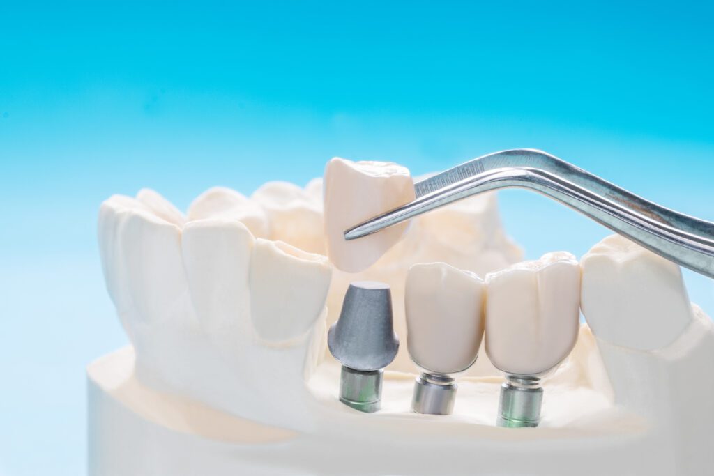 Dental Bridges in Cadillac, Michigan