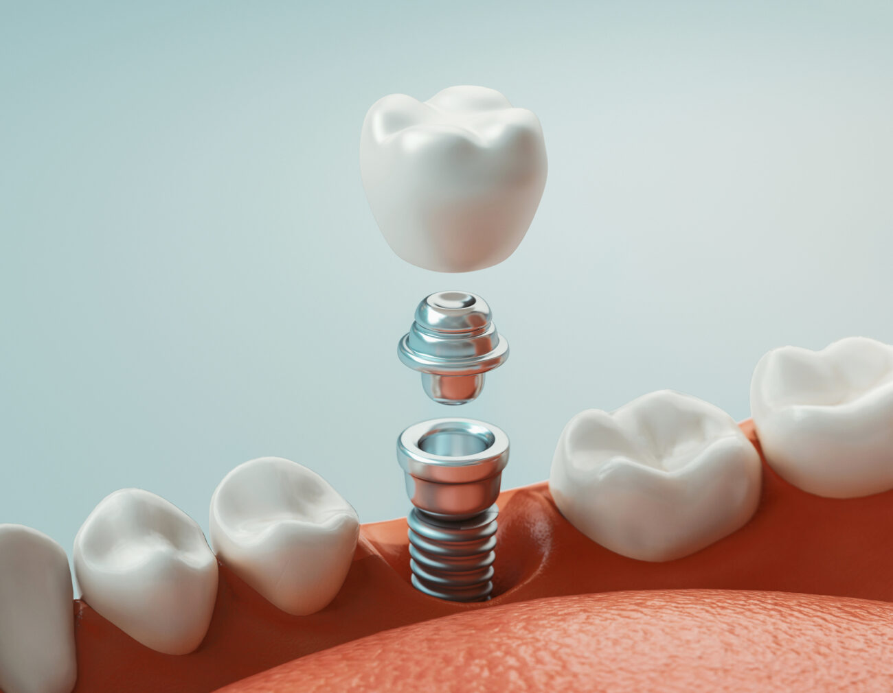 Things You Didn't Know About Dental Implants Cadillac, MI