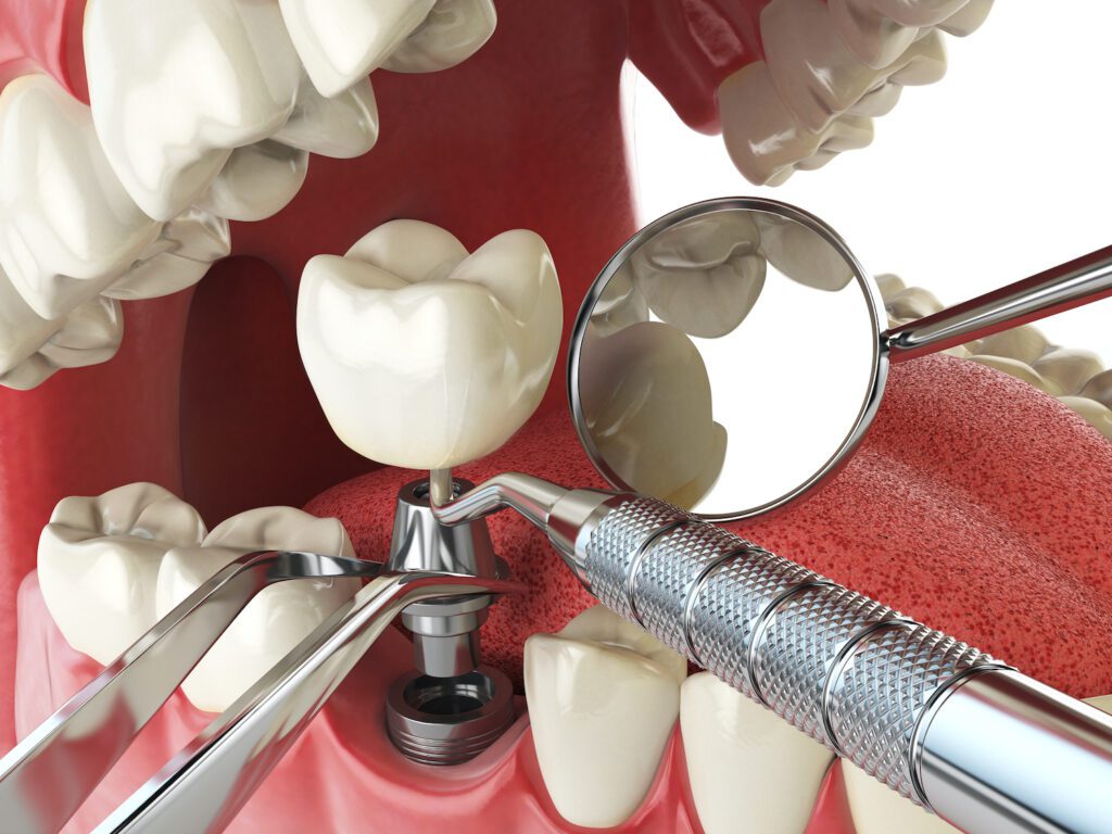 DENTAL IMPLANTS in CADILLAC MI have wonderful benefits, but they may not be for everyone