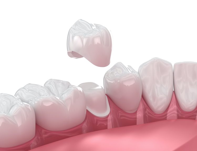 Dentists often recommend dental crowns for various reasons. They could provide both functional and aesthetic benefits.