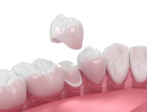 Does Getting a Dental Crown Hurt? in Cadillac, MI